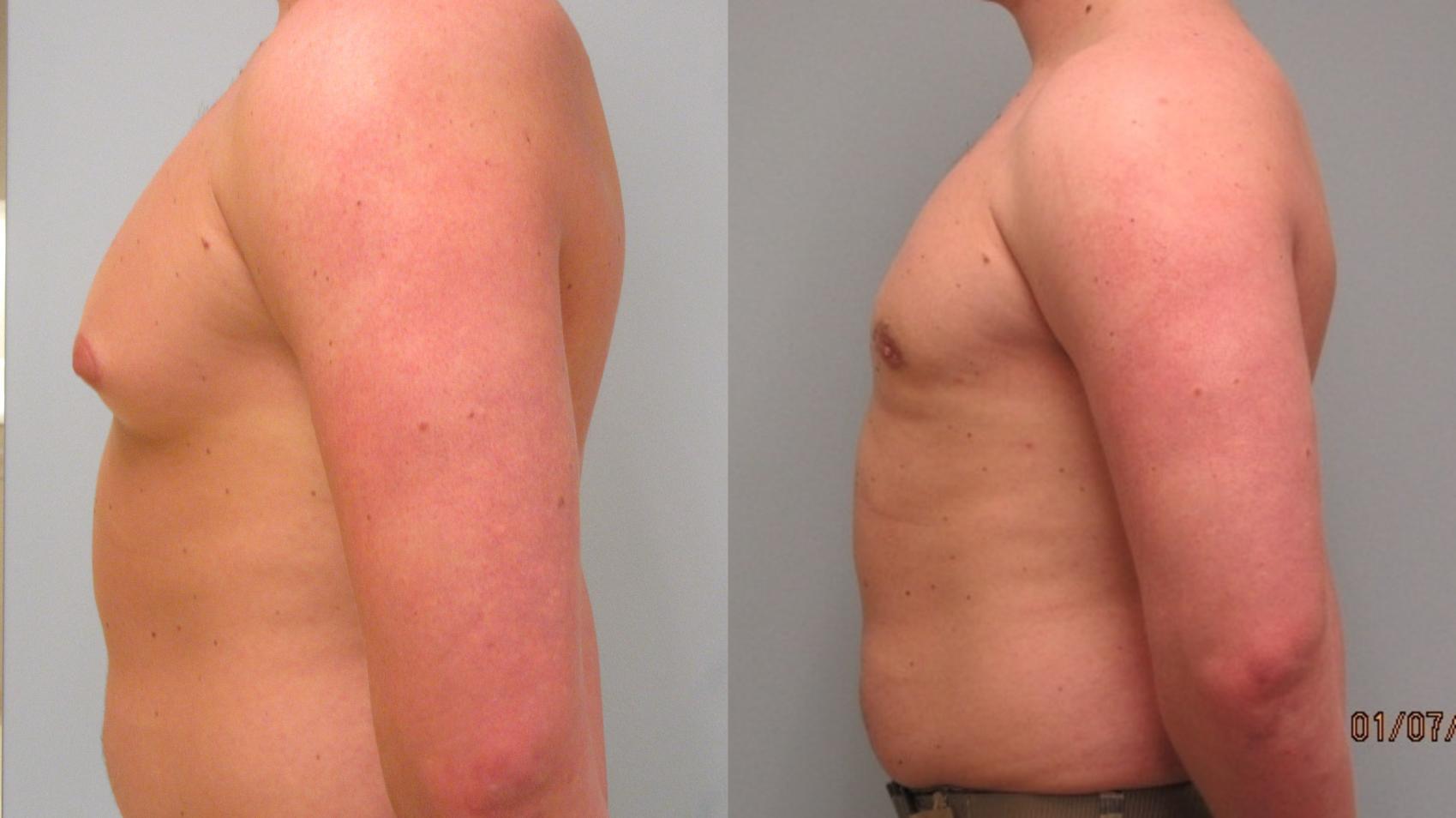 Before & After Gynecomastia Surgery Case 13 Left Side View in Anchorage, AK