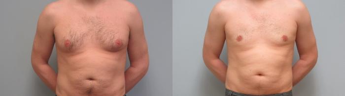 Before & After Gynecomastia Surgery Case 7 Front View in Anchorage, AK