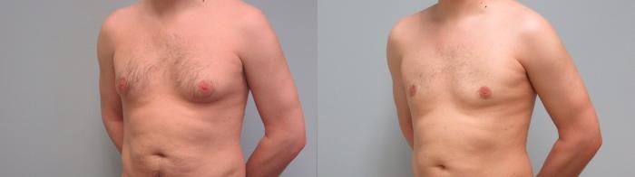 Before & After Gynecomastia Surgery Case 7 Left Oblique View in Anchorage, AK