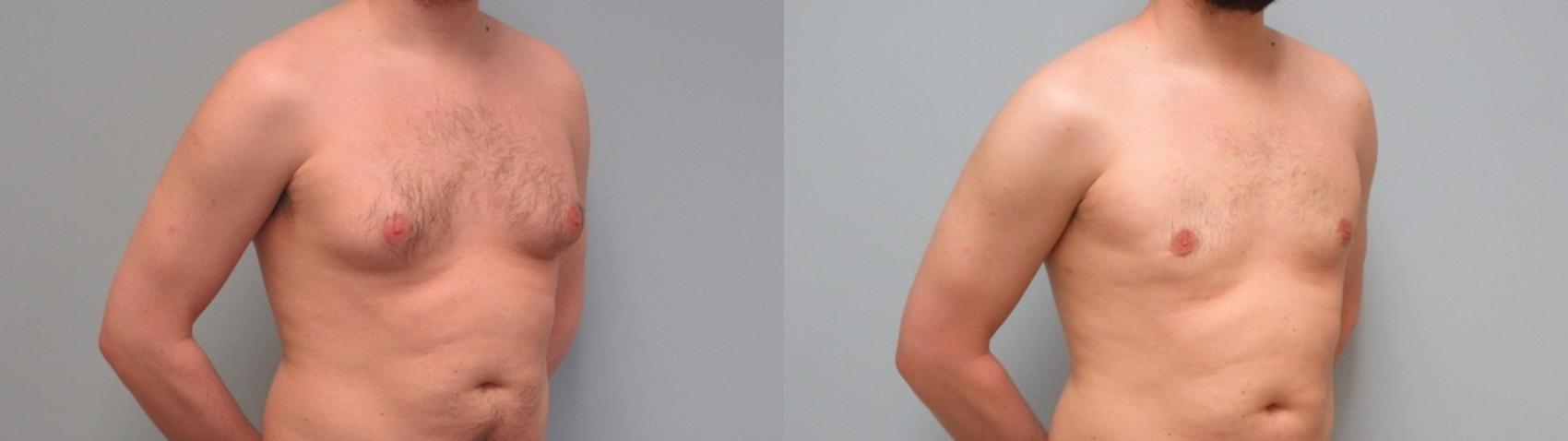 Before & After Gynecomastia Surgery Case 7 Right Oblique View in Anchorage, AK