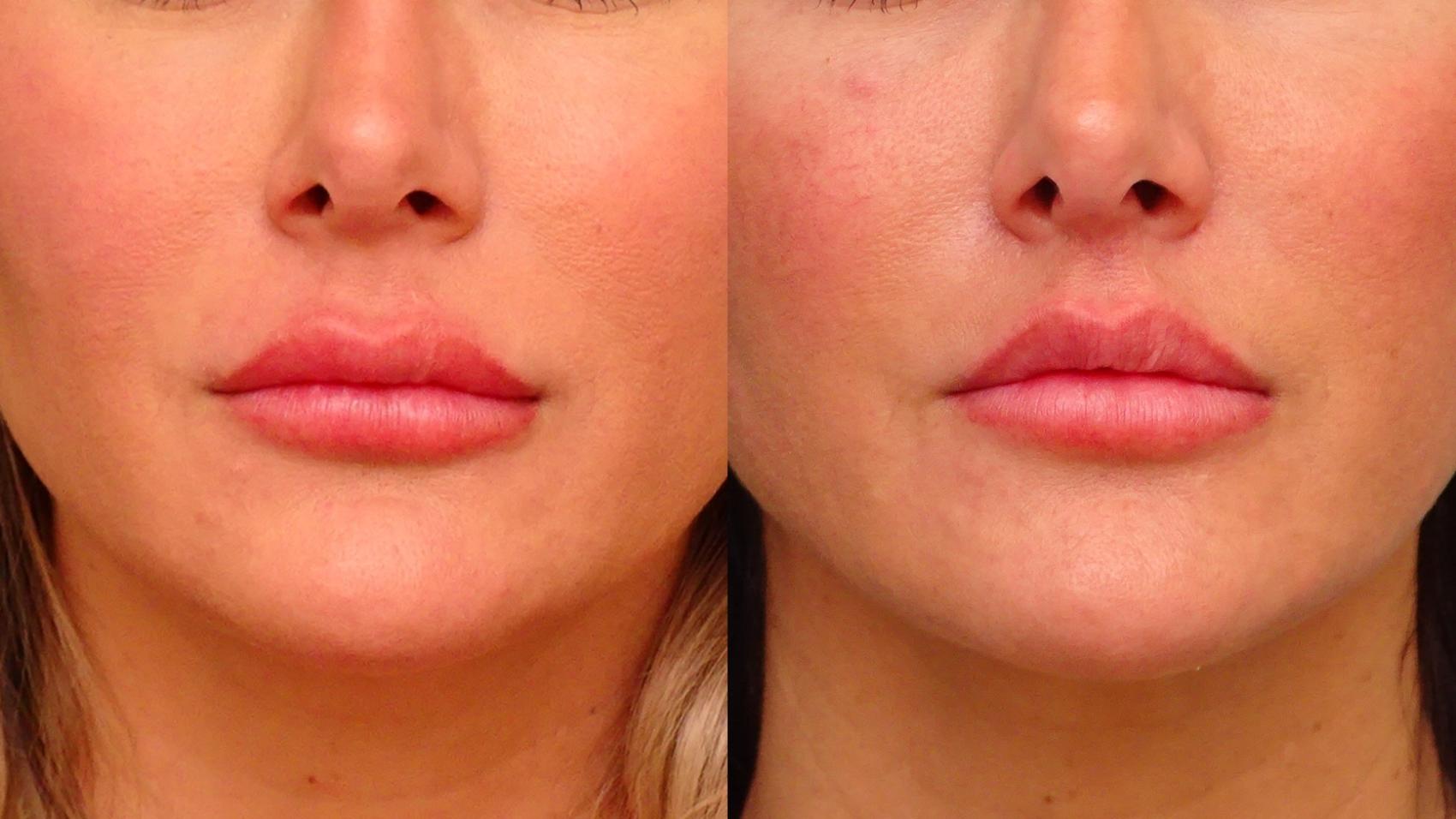 Before & After Lip Lift  Case 79 Front View in Anchorage, AK