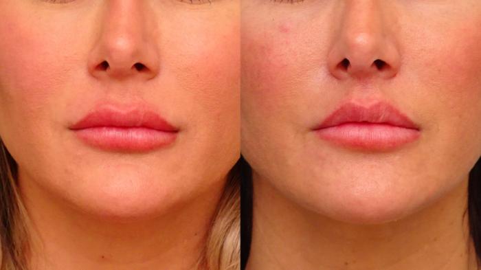 Before & After Lip Lift  Case 79 Front View in Anchorage, AK