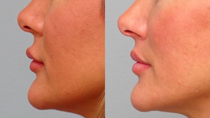 Before & After Lip Lift  Case 79 Left Side View in Anchorage, AK