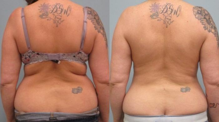 Before & After Liposuction Case 41 Back View in Anchorage, AK