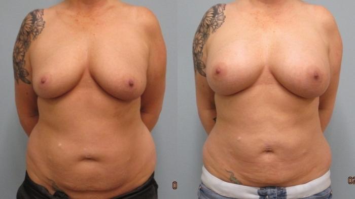 Before & After Liposuction Case 41 Front View in Anchorage, AK