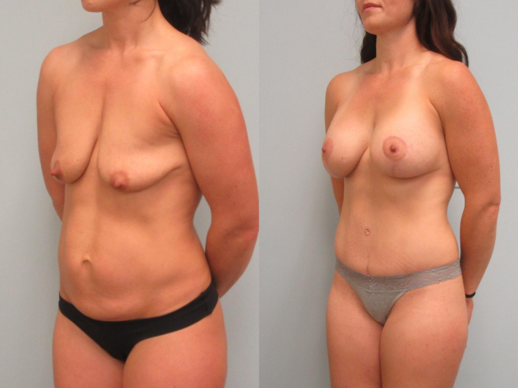Before & After Mommy Makeover Case 11 Left Oblique View in Anchorage, AK