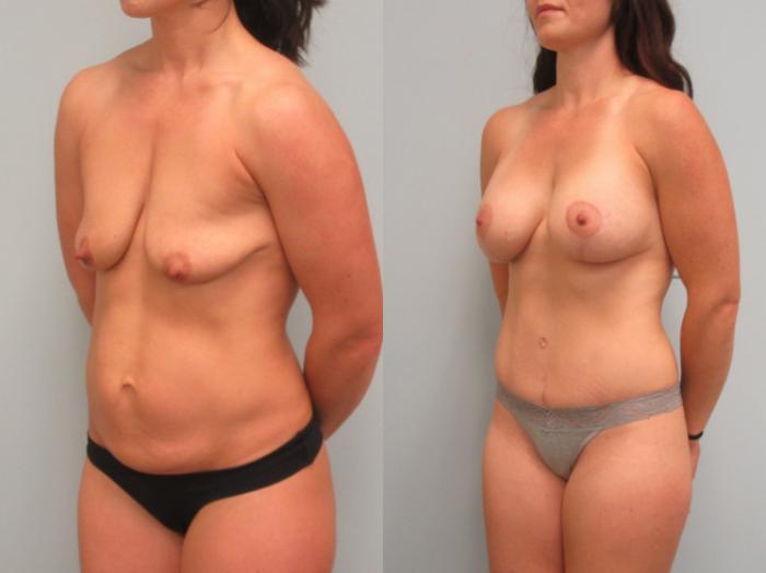 Before & After Mommy Makeover Case 11 Left Oblique View in Anchorage, AK
