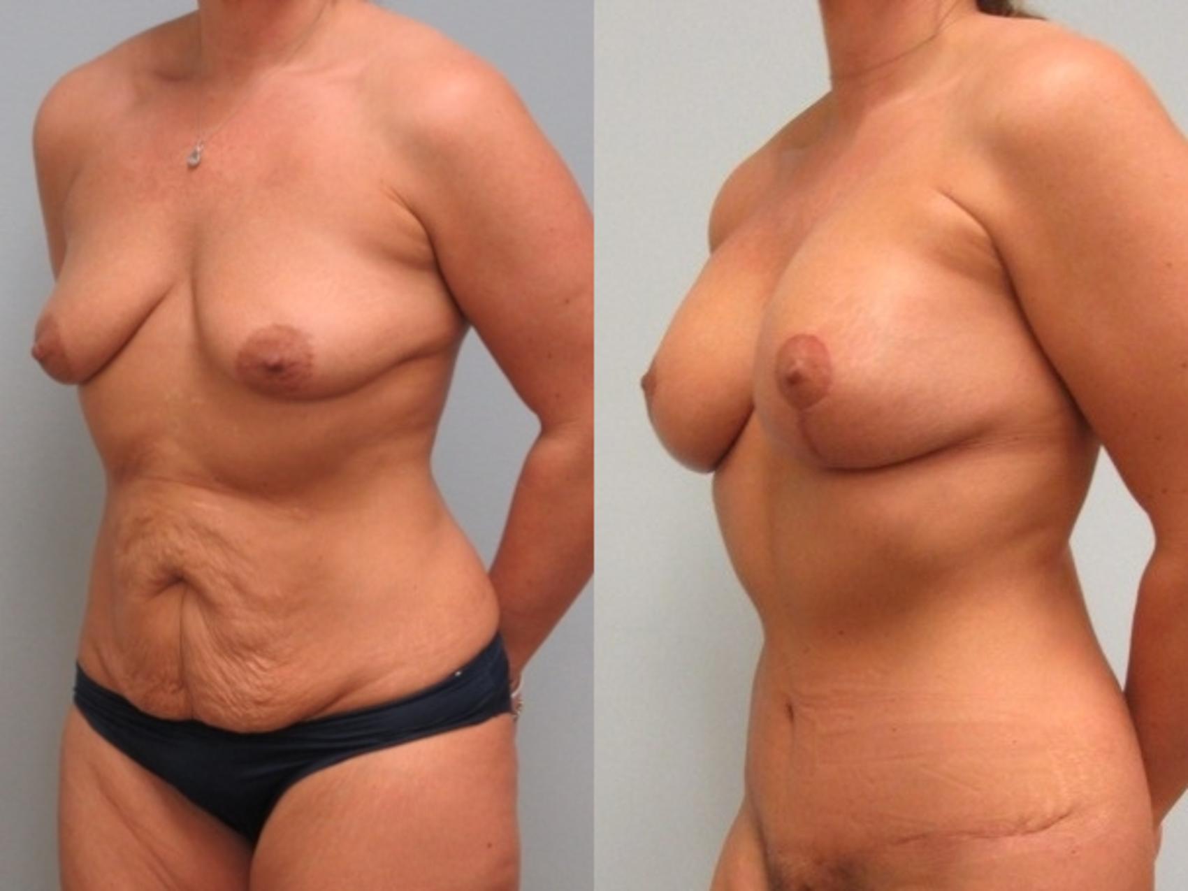 Before & After Mommy Makeover Case 18 Left Oblique View in Anchorage, AK
