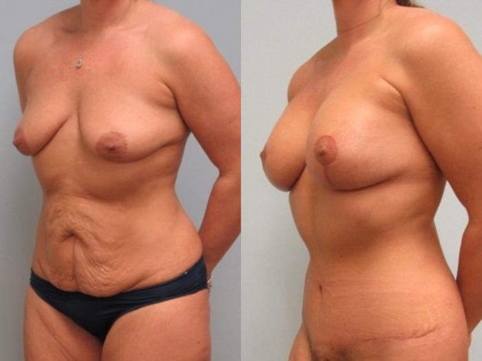 Before & After Mommy Makeover Case 18 Left Oblique View in Anchorage, AK