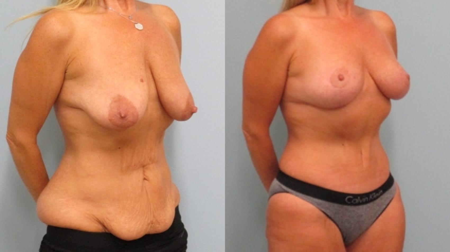 Before & After Mommy Makeover Case 34 Right Oblique View in Anchorage, AK