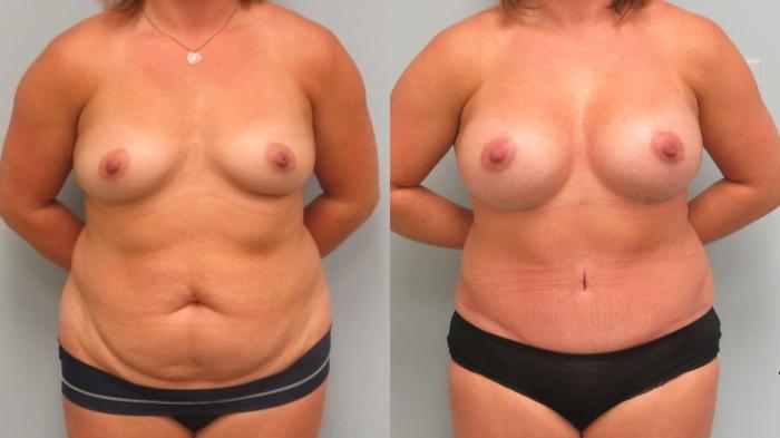 Before & After Breast Augmentation Case 5 Front View in Anchorage, AK