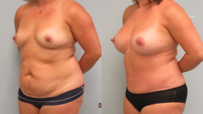 Before & After Tummy Tuck Case 5 Left Oblique View in Anchorage, AK