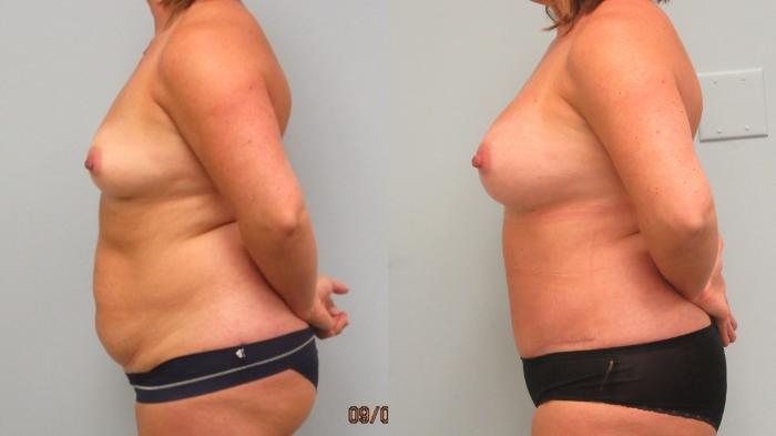 Before & After Breast Augmentation Case 5 Left Side View in Anchorage, AK