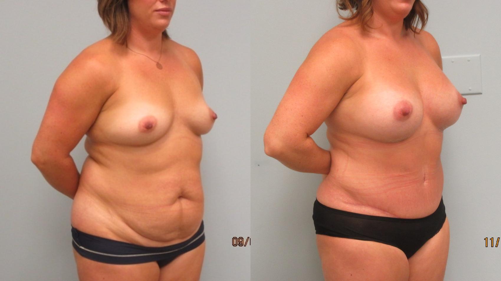 Before & After Mommy Makeover Case 5 Right Oblique View in Anchorage, AK