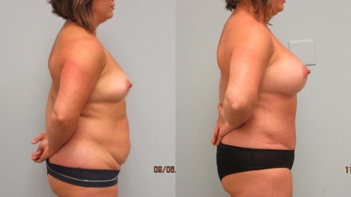 Before & After Breast Augmentation Case 5 Right Side View in Anchorage, AK