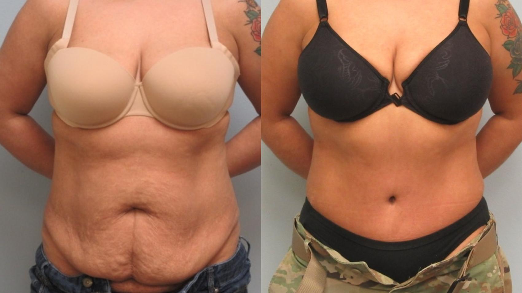 Before & After Tummy Tuck Case 16 Front View in Anchorage, AK