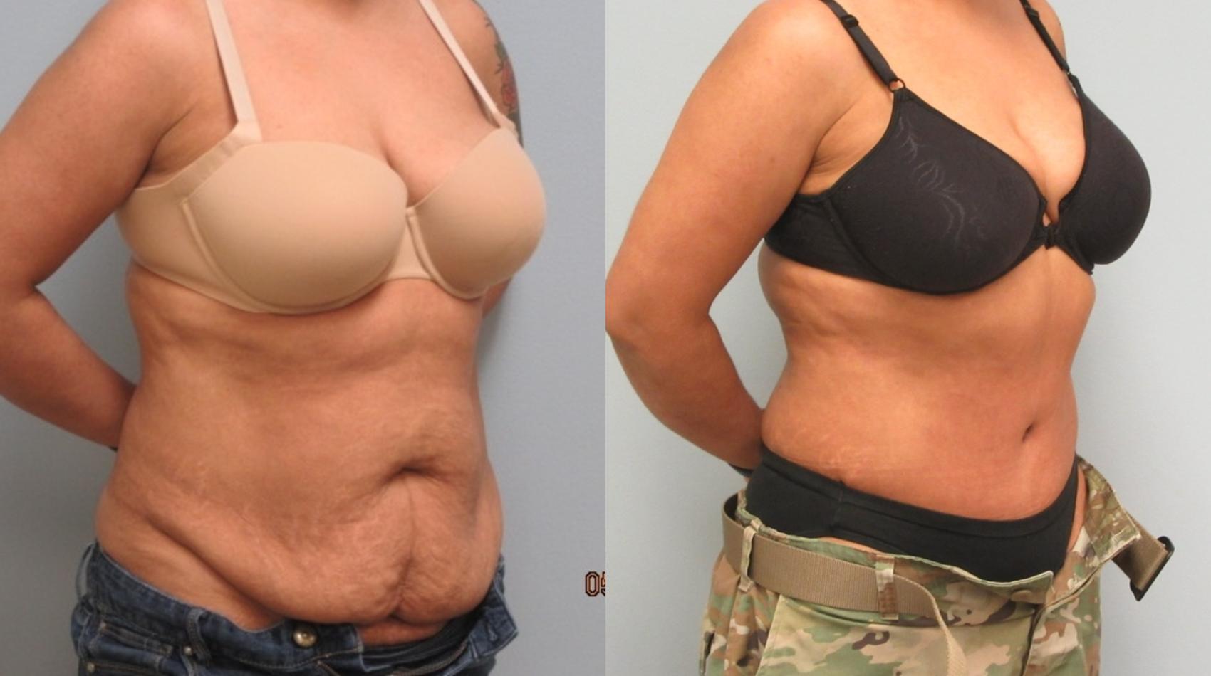 Before & After Tummy Tuck Case 16 Right Oblique View in Anchorage, AK