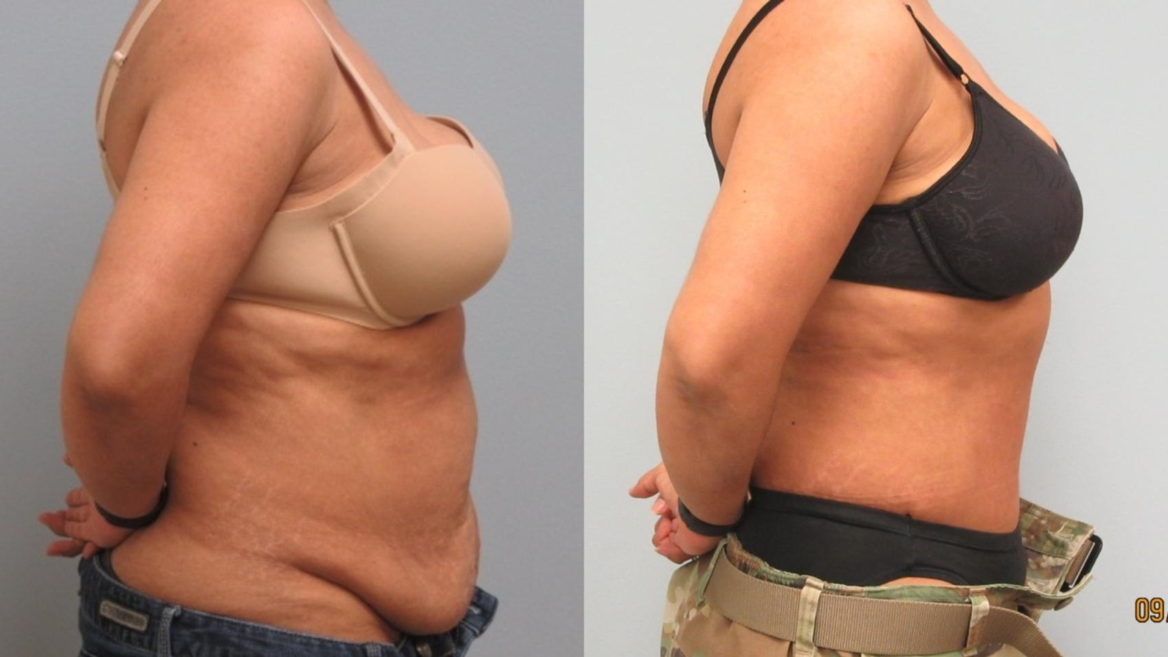 Before & After Tummy Tuck Case 16 Right Side View in Anchorage, AK