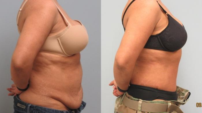 Before & After Tummy Tuck Case 16 Right Side View in Anchorage, AK