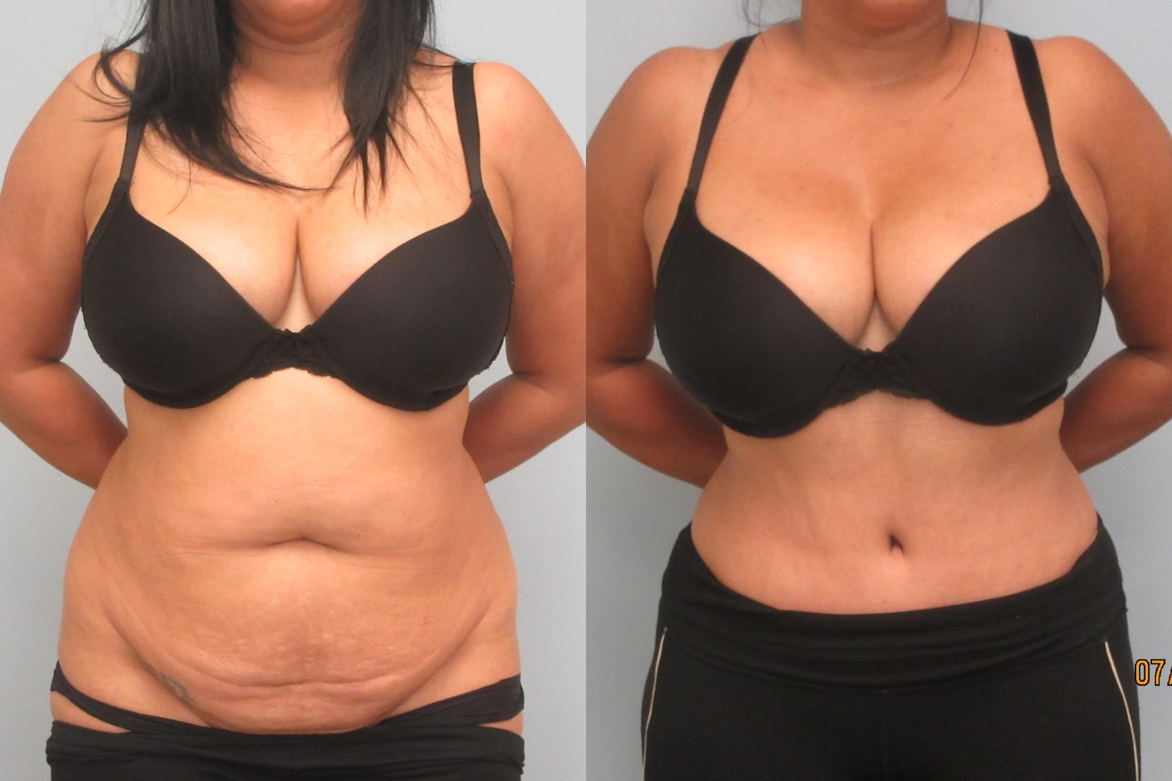 Before & After Tummy Tuck Case 21 Front View in Anchorage, AK