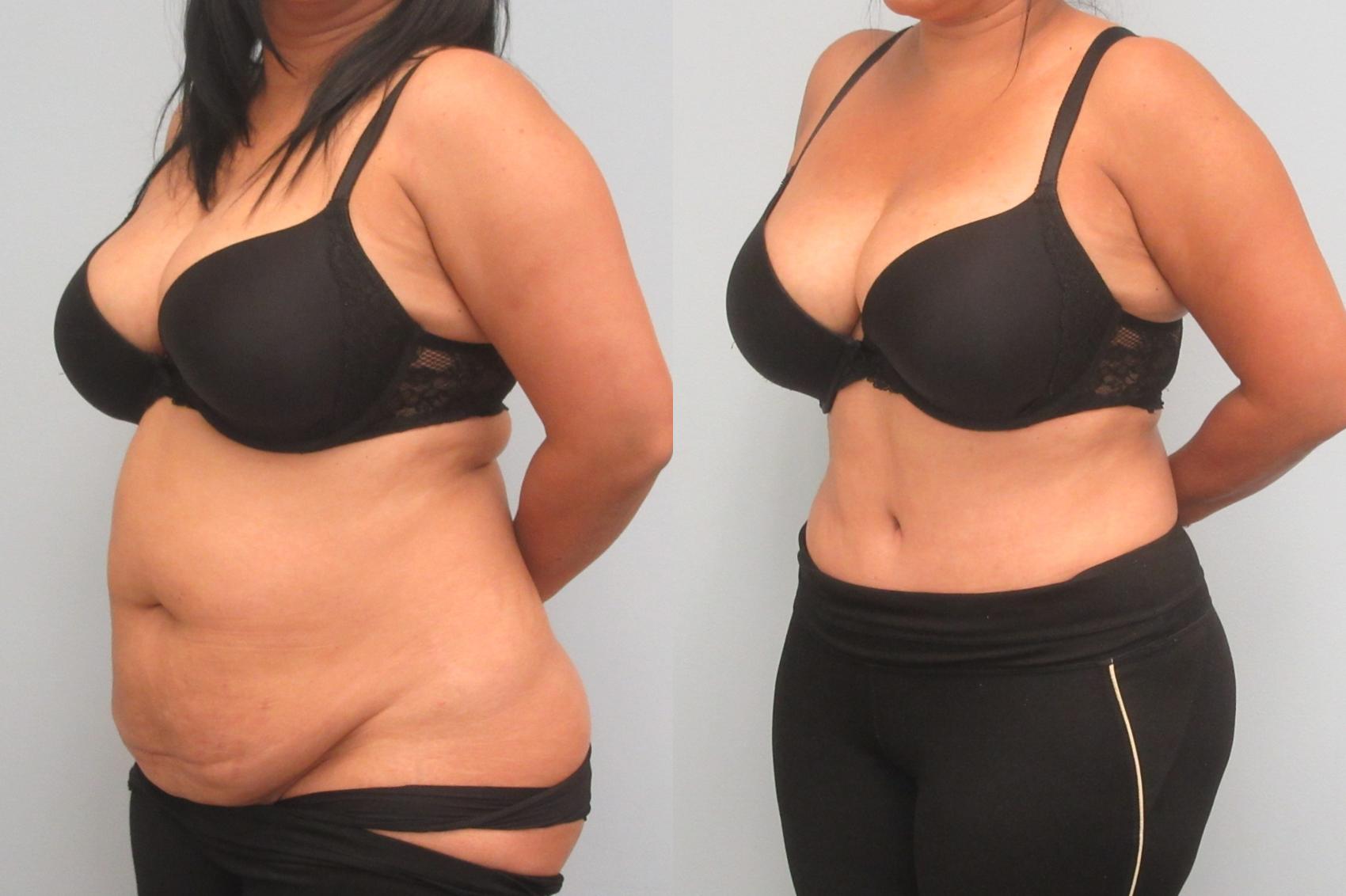 Before & After Tummy Tuck Case 21 Left Oblique View in Anchorage, AK
