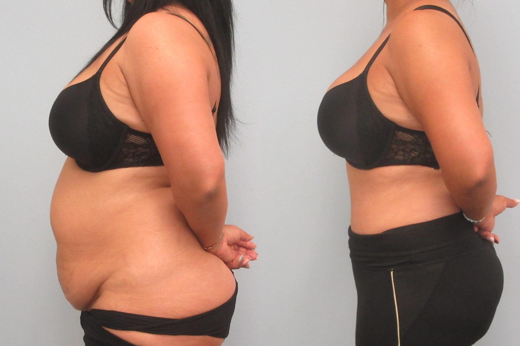 Before & After Tummy Tuck Case 21 Left Side View in Anchorage, AK