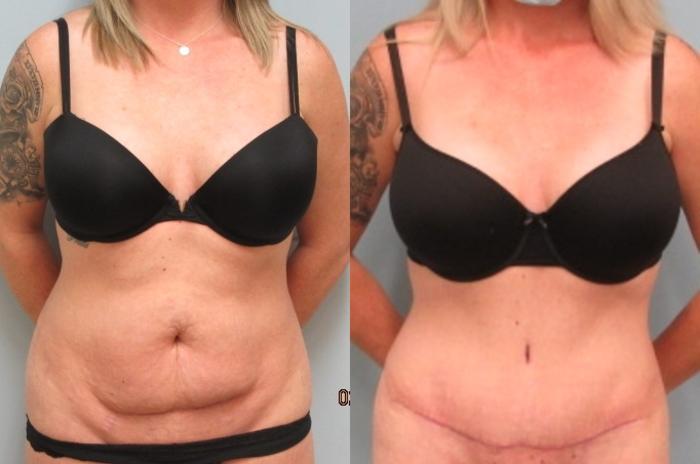 Before & After Tummy Tuck Case 23 Front View in Anchorage, AK