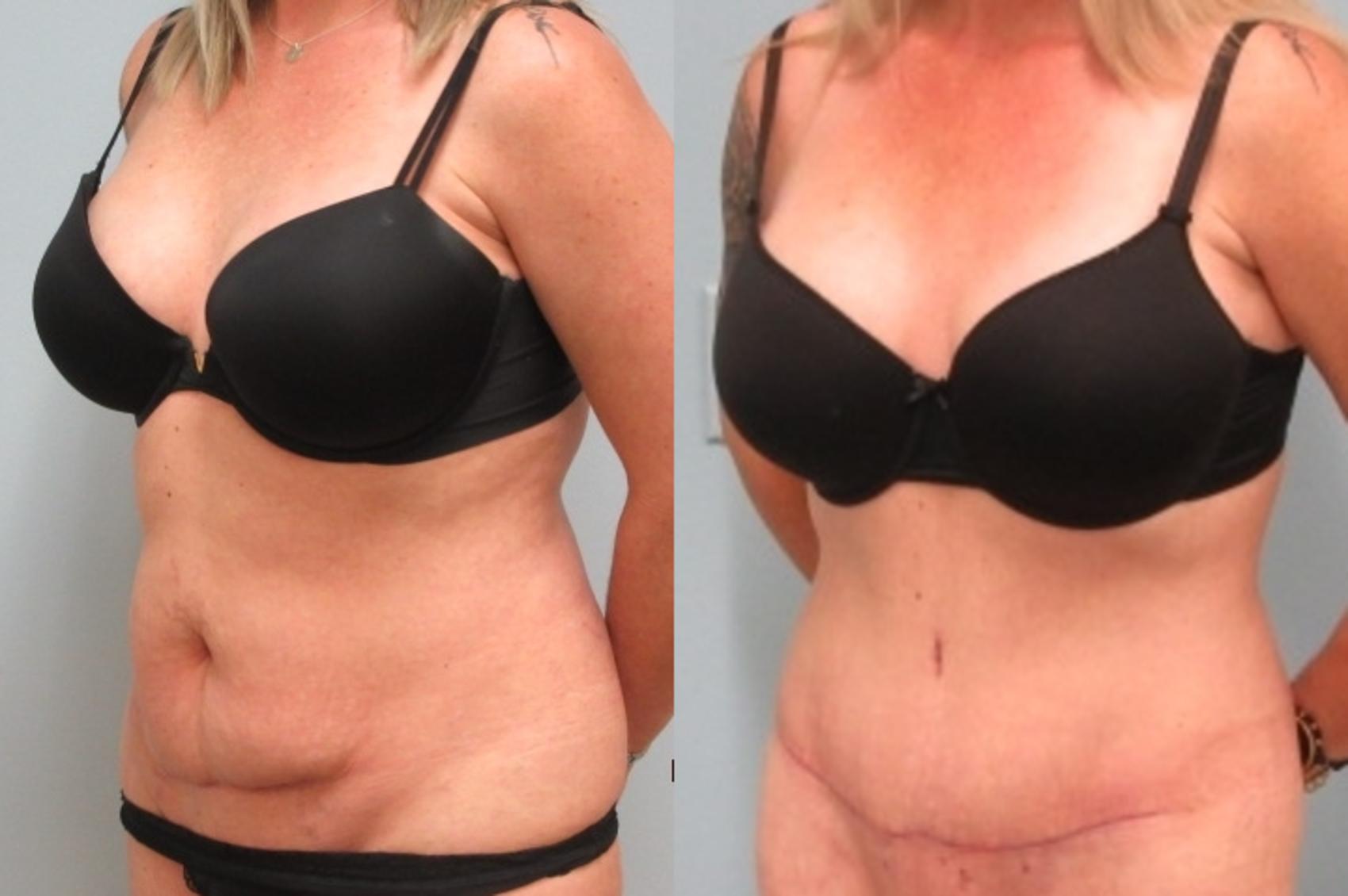 Before & After Tummy Tuck Case 23 Left Oblique View in Anchorage, AK