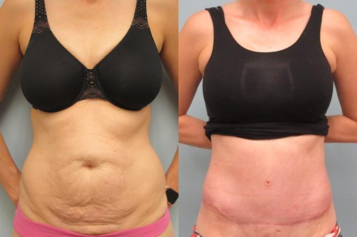 Before & After Tummy Tuck Case 24 Front View in Anchorage, AK