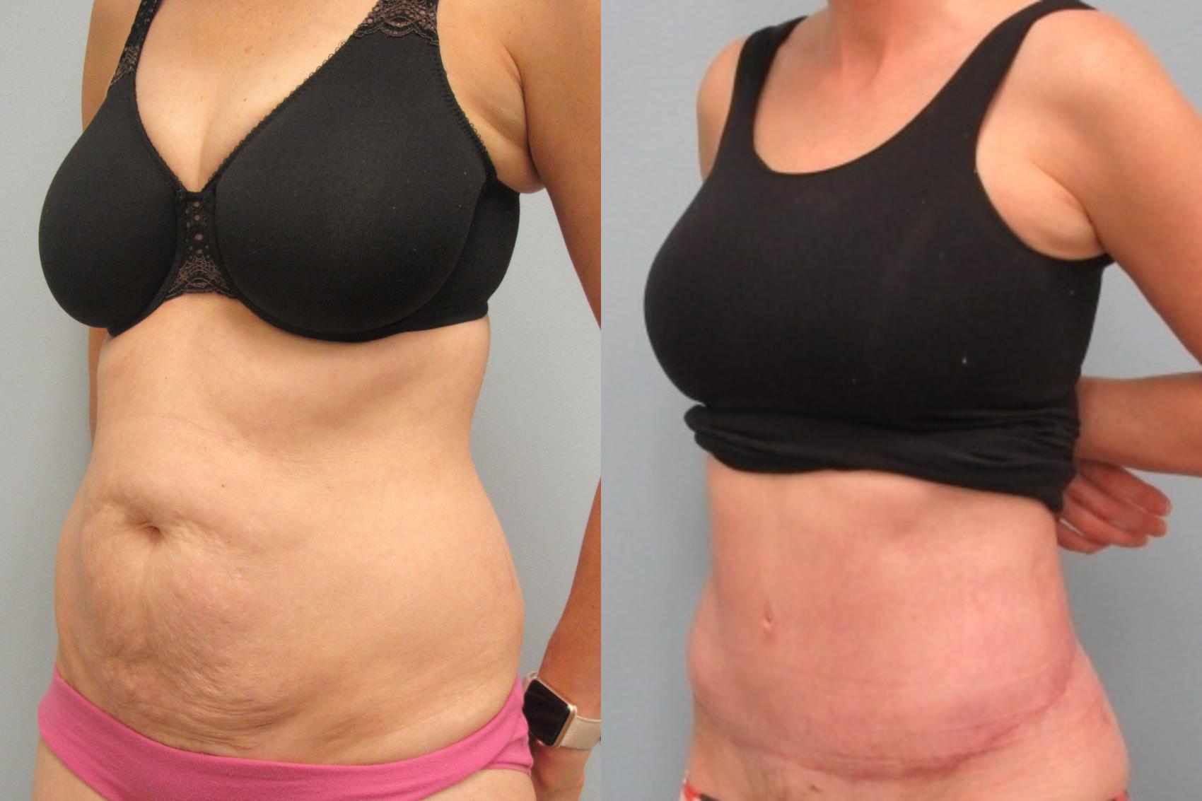 Before & After Tummy Tuck Case 24 Left Oblique View in Anchorage, AK