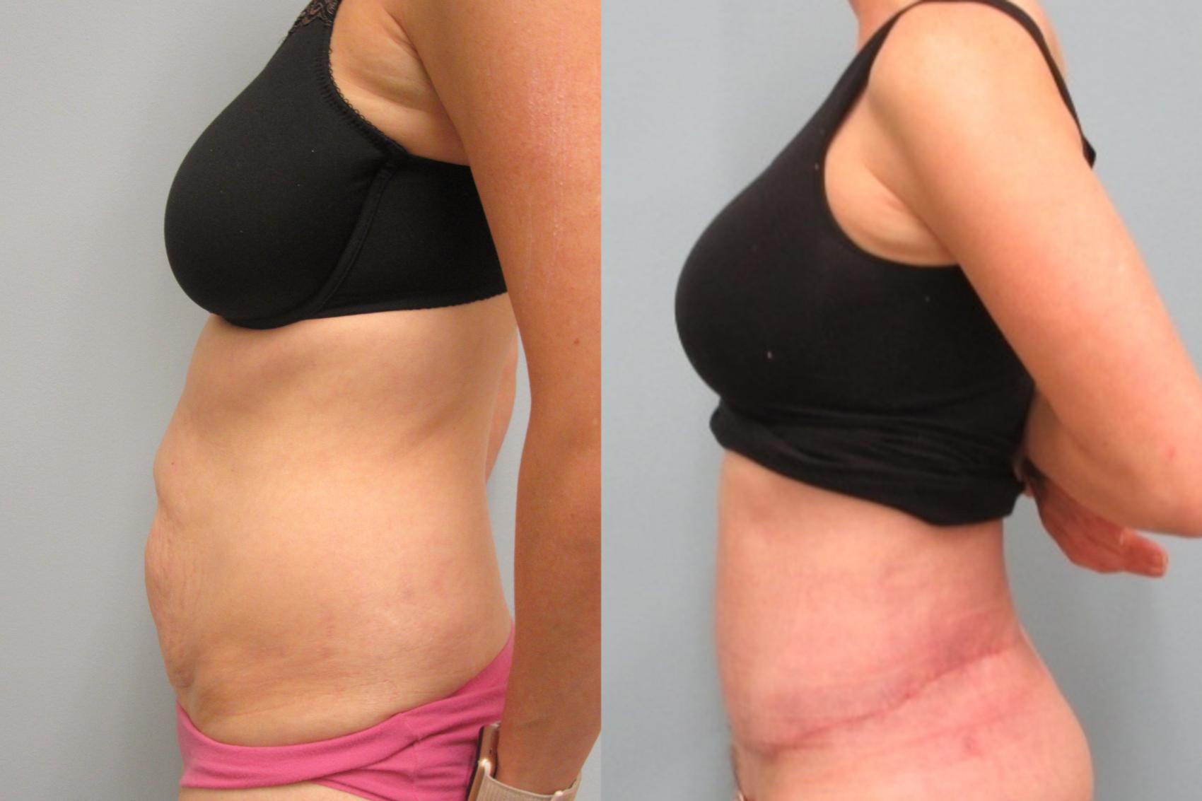 Before & After Tummy Tuck Case 24 Left Side View in Anchorage, AK