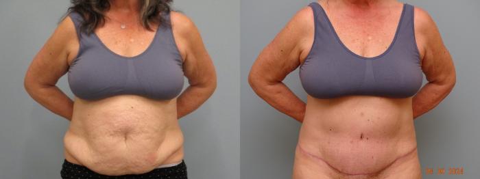 Before & After Tummy Tuck Case 68 Front View in Anchorage, AK