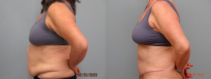 Before & After Tummy Tuck Case 68 Left Oblique View in Anchorage, AK