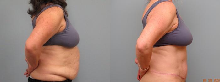 Before & After Tummy Tuck Case 68 Right Side View in Anchorage, AK