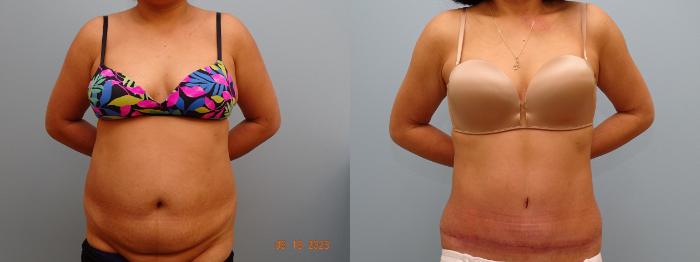 Before & After Tummy Tuck Case 69 Front View in Anchorage, AK