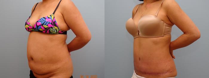 Before & After Tummy Tuck Case 69 Left Oblique View in Anchorage, AK