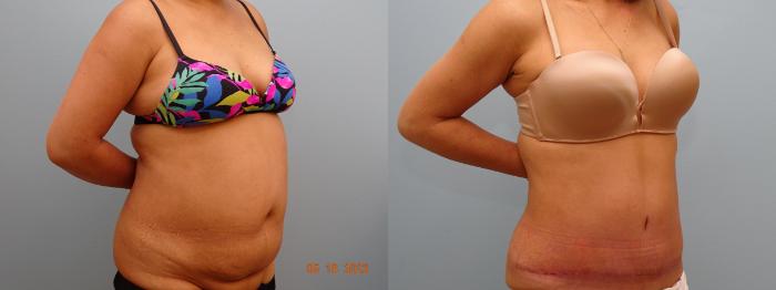 Before & After Tummy Tuck Case 69 Right Oblique View in Anchorage, AK