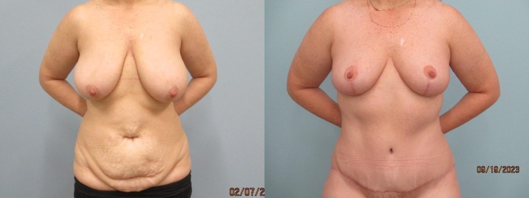 Before & After Tummy Tuck Case 70 Front View in Anchorage, AK