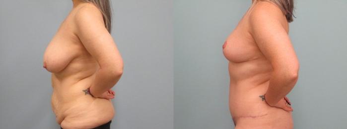 Before & After Tummy Tuck Case 70 Left Side View in Anchorage, AK