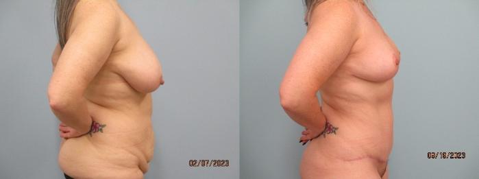 Before & After Tummy Tuck Case 70 Right Side View in Anchorage, AK