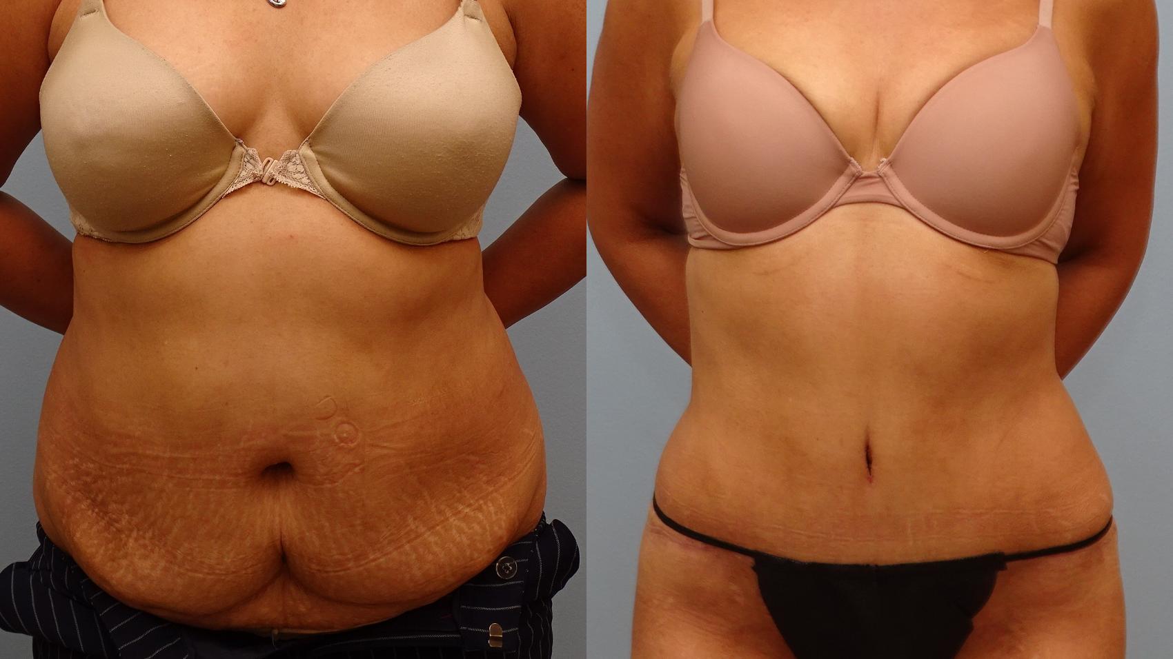 Before & After Tummy Tuck Case 77 Front View in Anchorage, AK