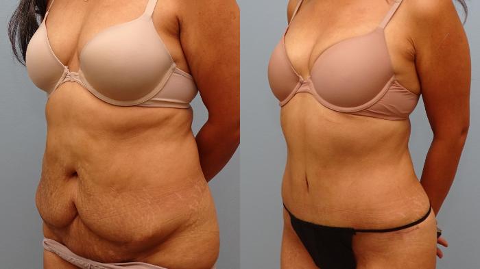 Before & After Tummy Tuck Case 77 Left Oblique View in Anchorage, AK