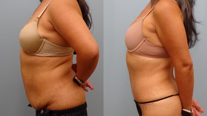 Before & After Tummy Tuck Case 77 Left Side View in Anchorage, AK