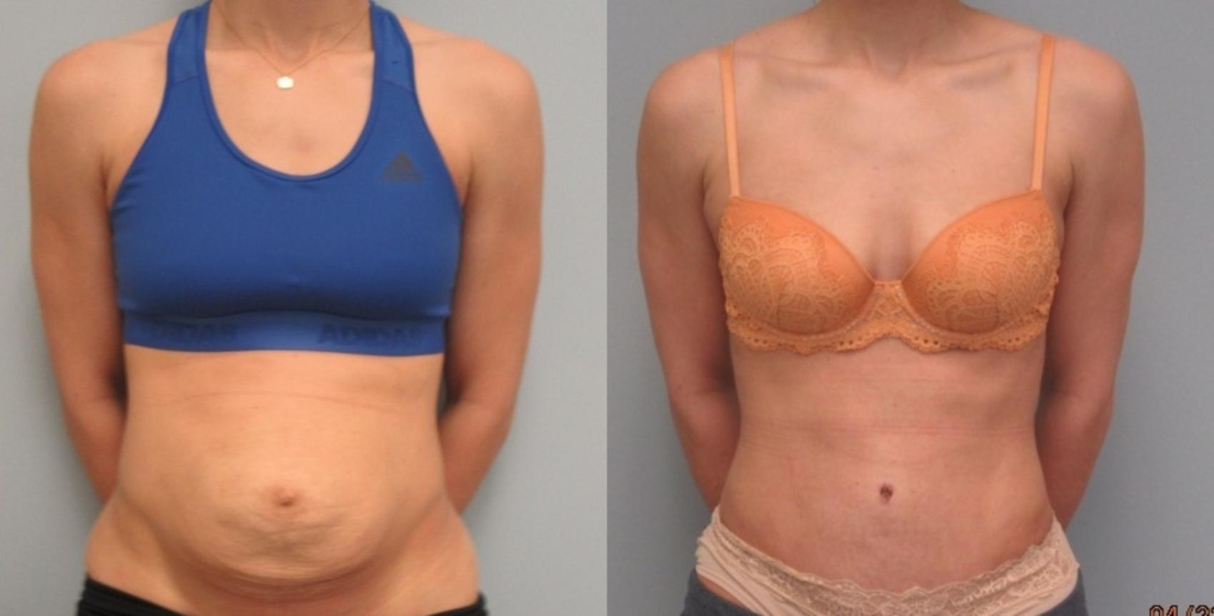 Before & After Tummy Tuck Case 9 Front View in Anchorage, AK