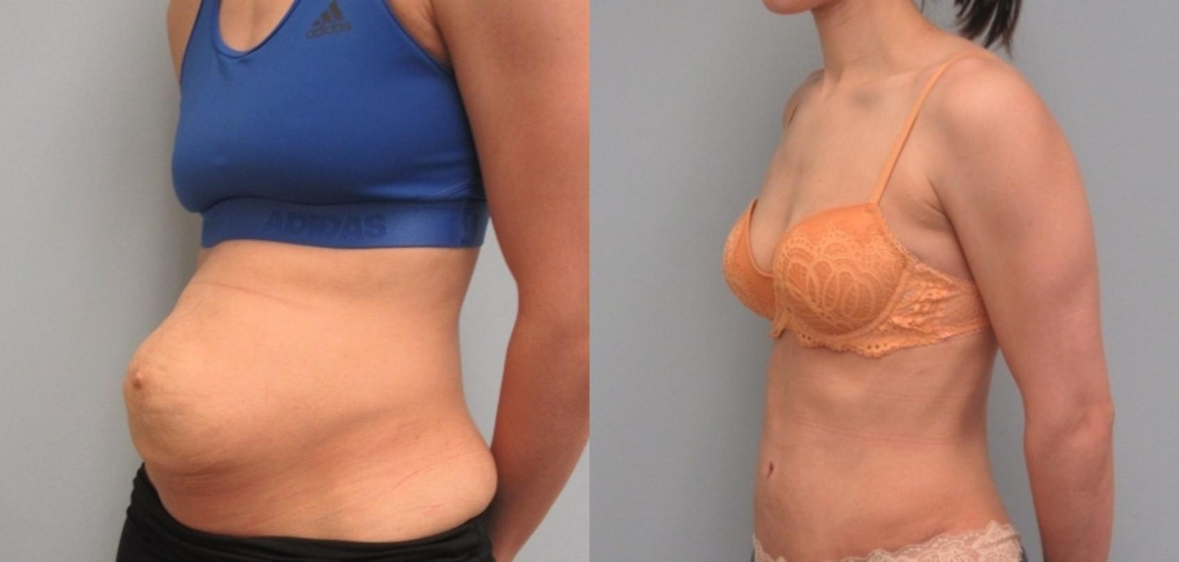 Before & After Tummy Tuck Case 9 Left Oblique View in Anchorage, AK