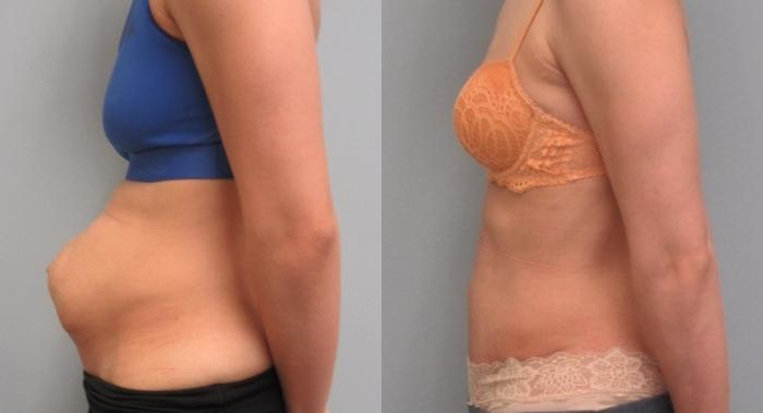 Before & After Tummy Tuck Case 9 Left Side View in Anchorage, AK