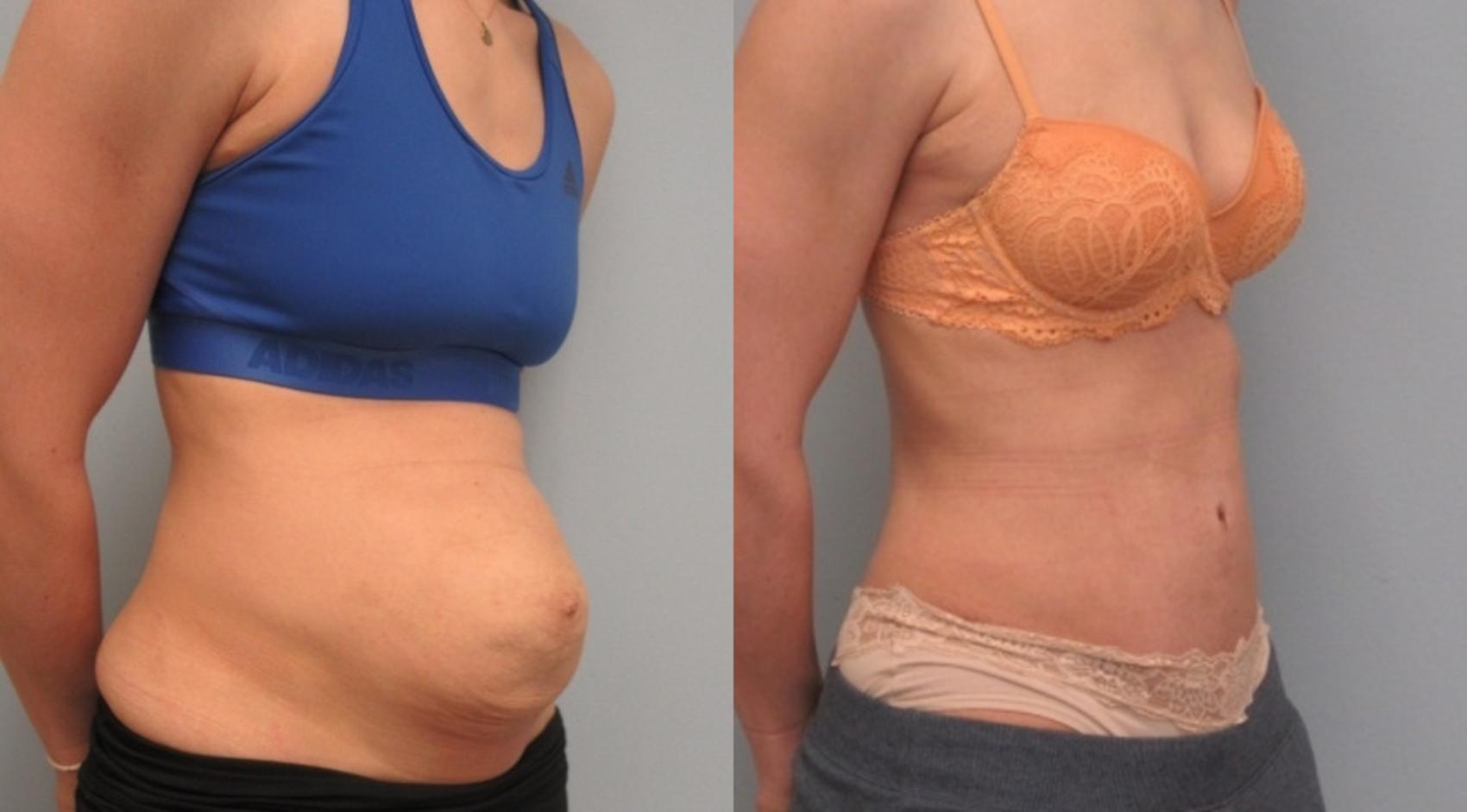 Before & After Tummy Tuck Case 9 Right Oblique View in Anchorage, AK